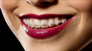 orthodontic clinics taipei Rebecca Chen Braces Invisalign 陳盈安 矯正 隱適美